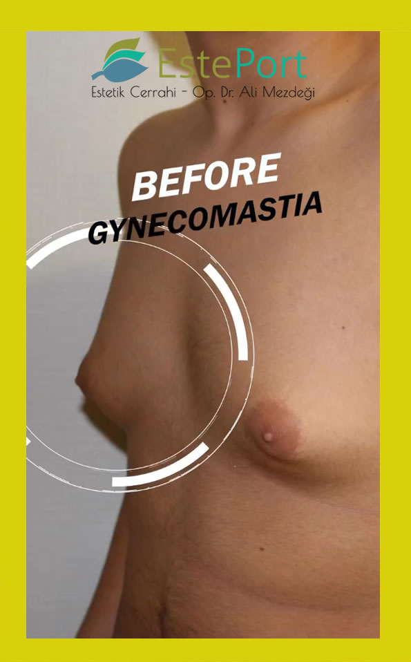 Ätiologie der Gynäkomastie