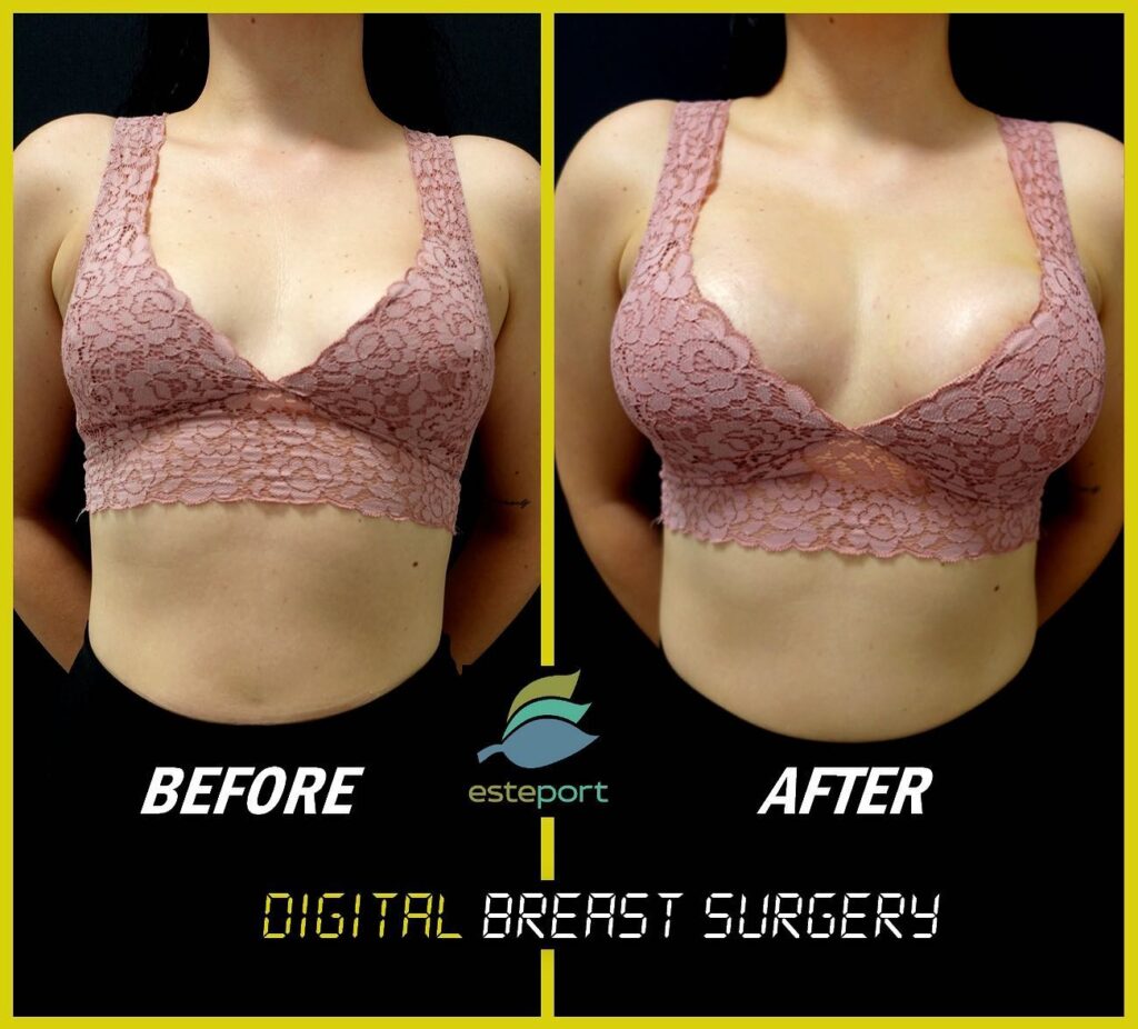 Breast Asymmetry Surgery Turkey