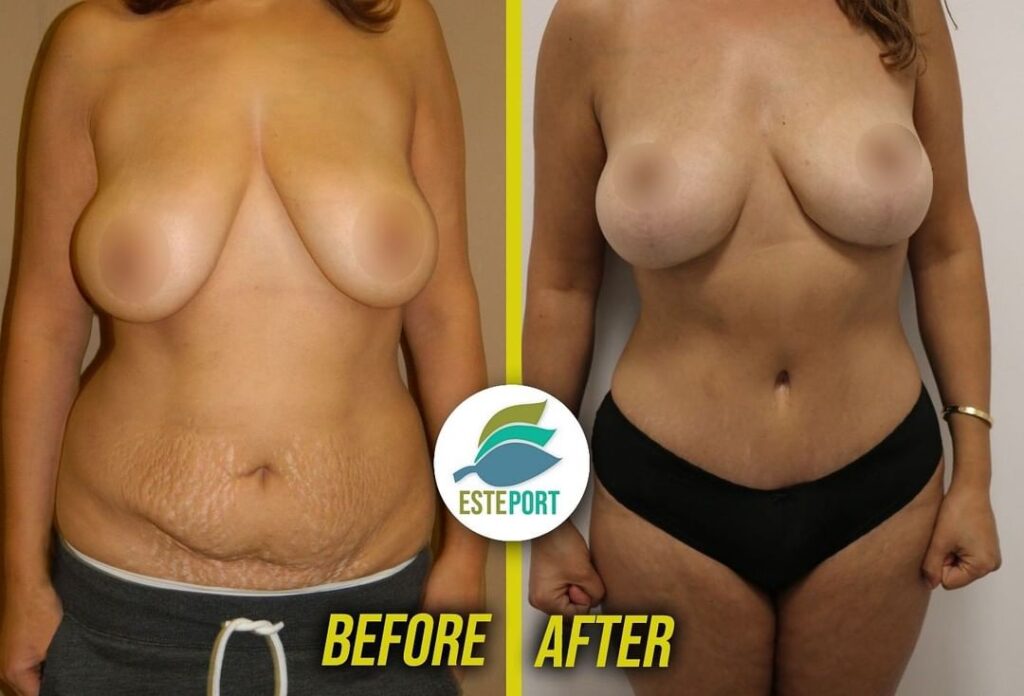 Breast Lift With Implants Turkey