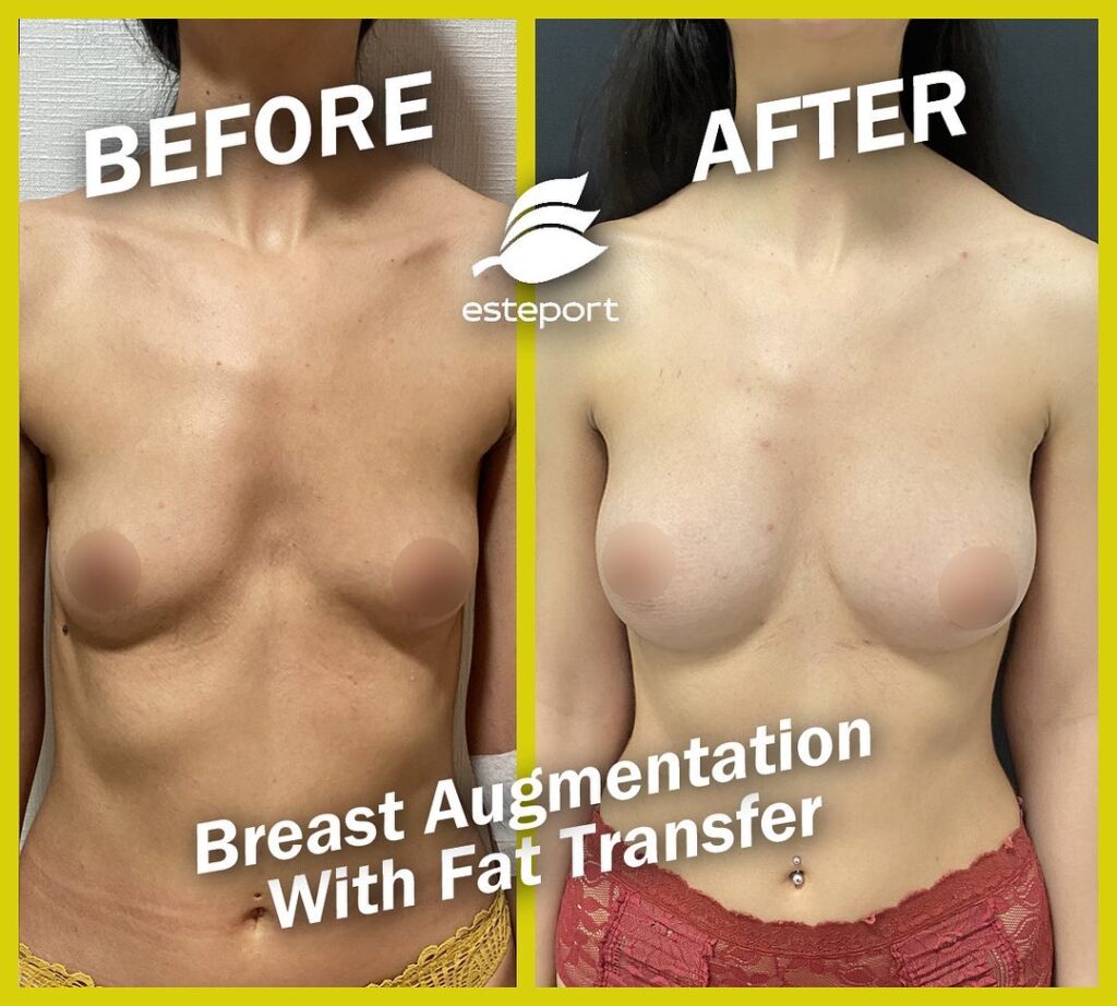 Breast Reconstruction Surgery Turkey