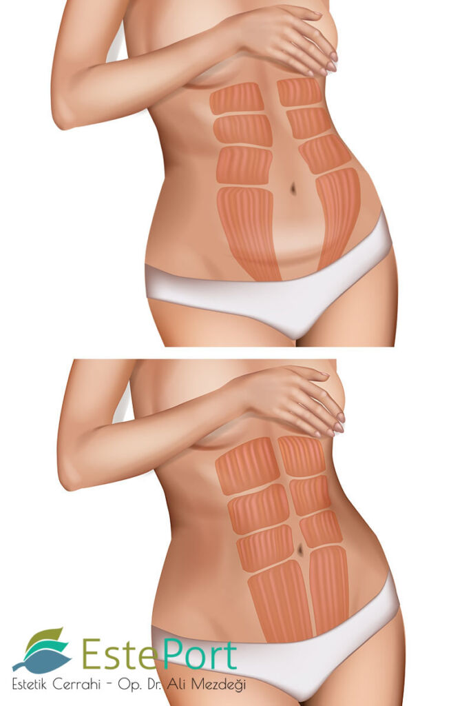 Der Heilungsverlauf nach einer Bauchdeckenstraffung