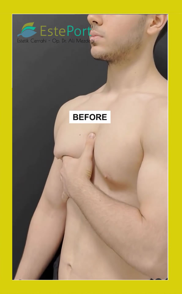 Gynäkomastie Istanbul