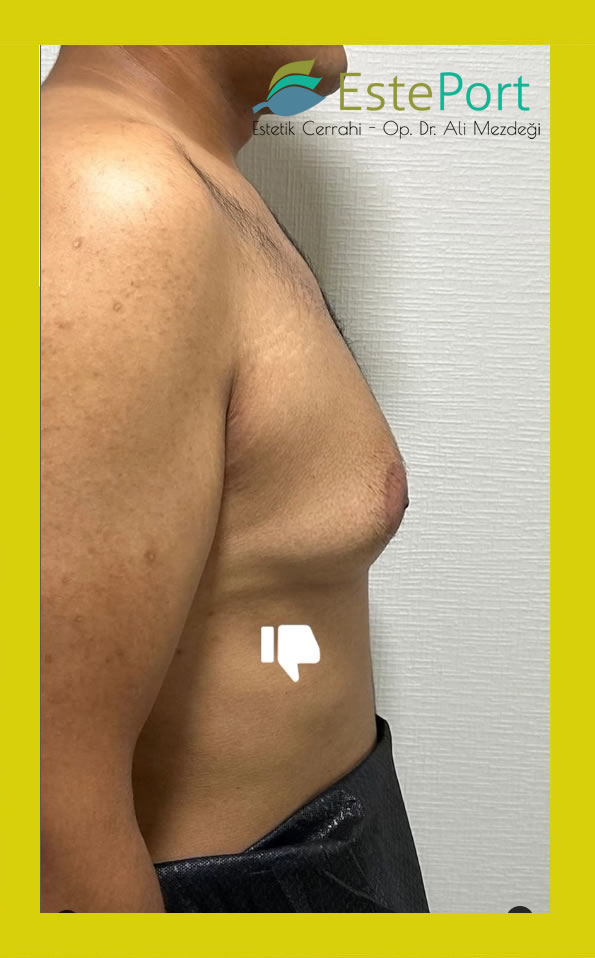 Gynäkomastie Türkei