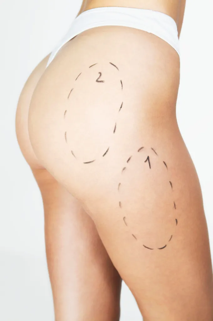 Leg Vaser Liposuction Turkey