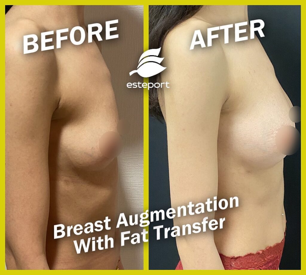 Liposuction Breast Reduction Turkey