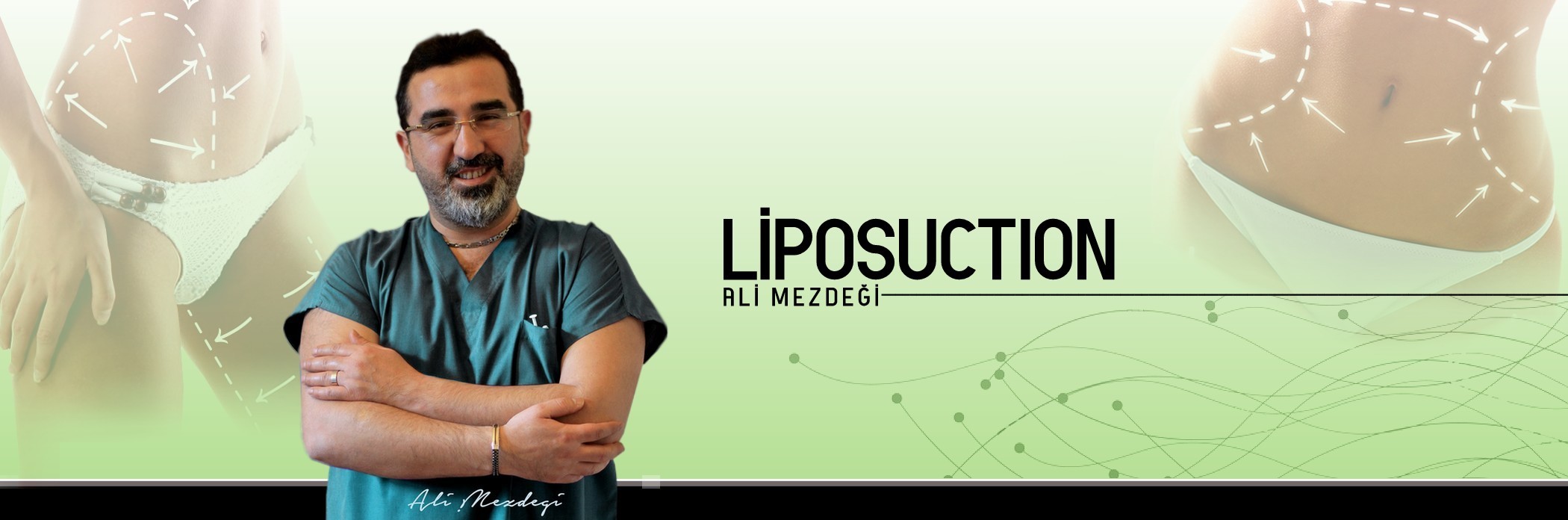 Liposuction(Yağ Emme)