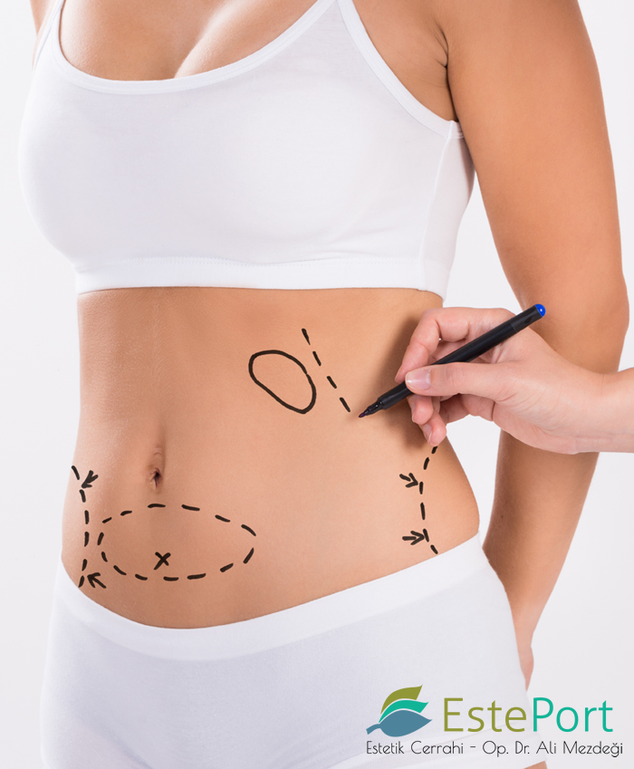 Liposuktion der Taille