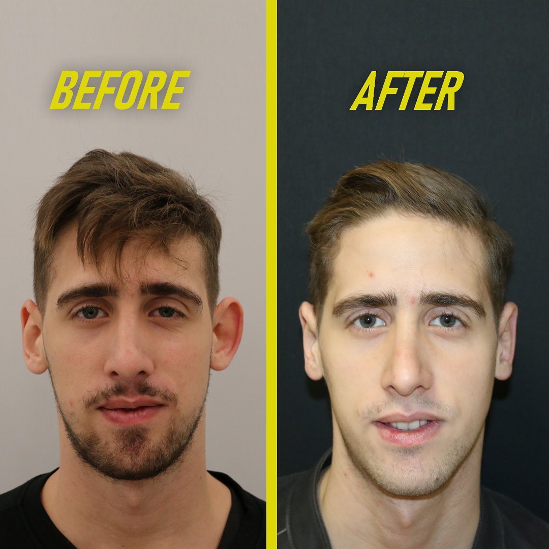 Non surgical ear surgery before after