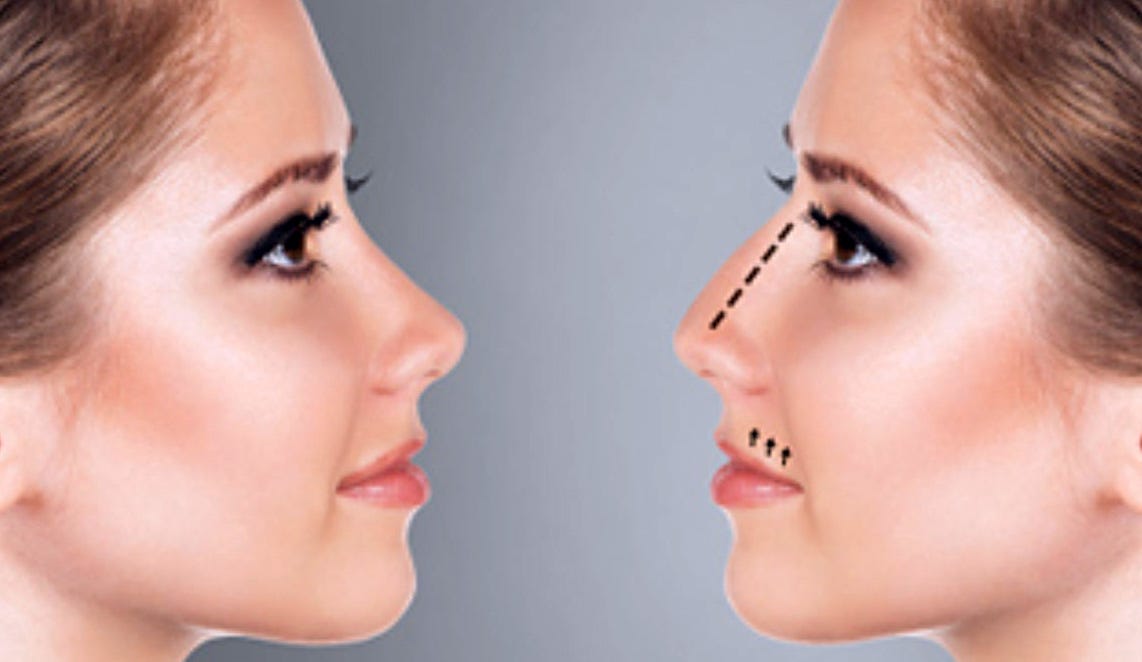 Nose Thread Lift Turkey Price 2024 Dr. Ali Mezdeği Istanbul