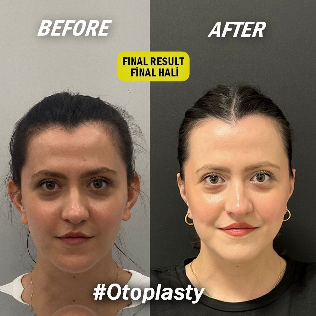 Otoplasty in Turkey