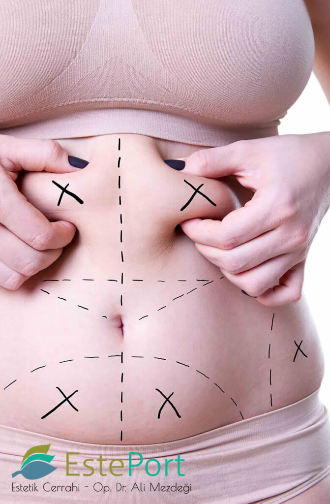 Risiken der Bauchdeckenstraffung