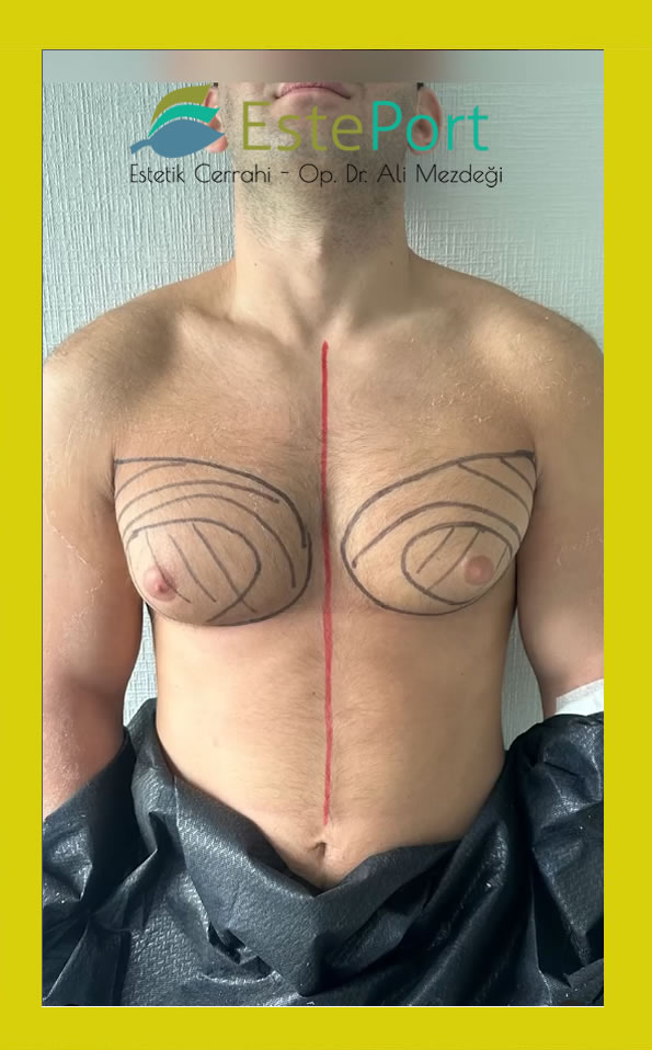 Schweregrade der Gynäkomastie