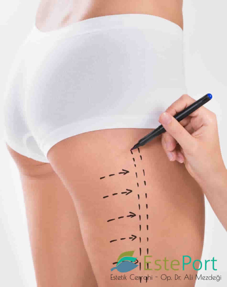 Vaser Hi-Def Liposuction in Turkey
