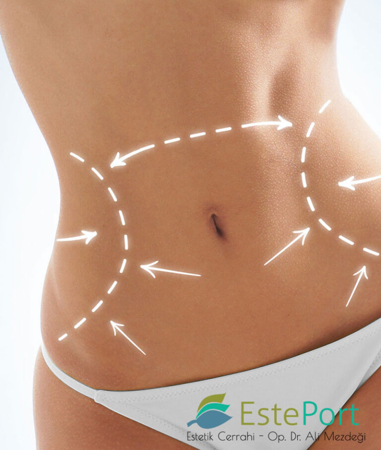 Vaser Liposuction in Turkey