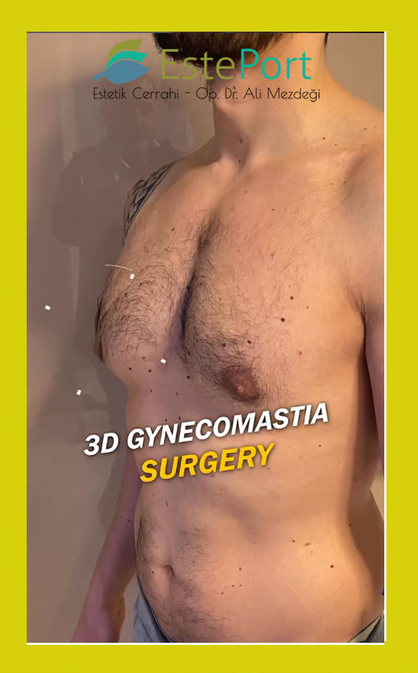 Welche Arten von Gynäkomastie gibt es