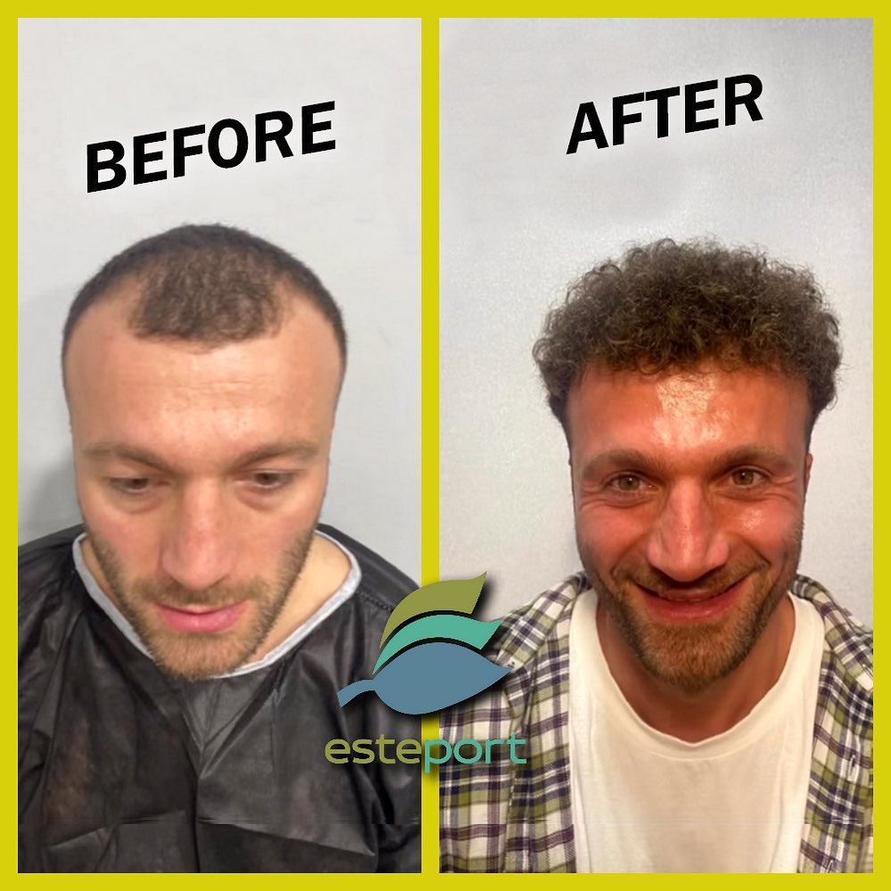 dhi hair transplant turkey - Before - After -2