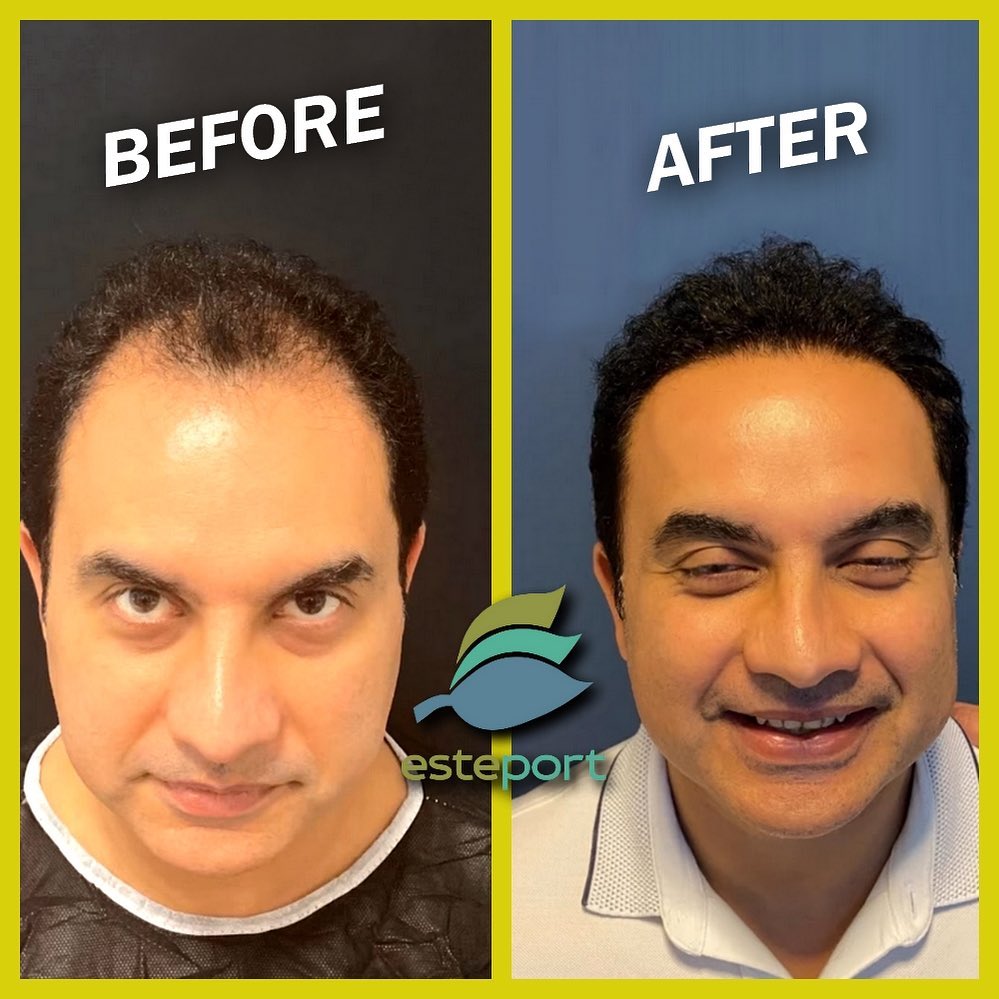 dhi hair transplant turkey - Before - After -3