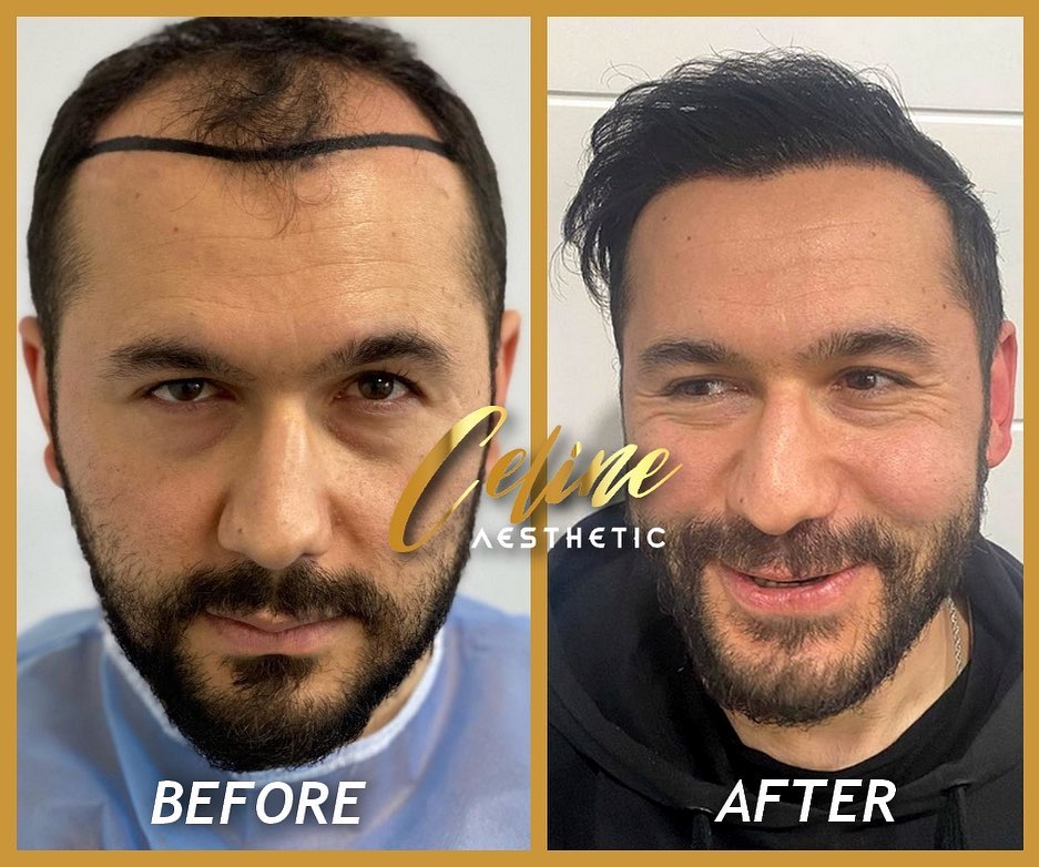 hair transplant ali mezdeği before after 1