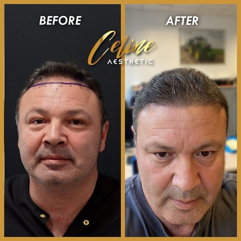 hair transplant ali mezdeği before after 2