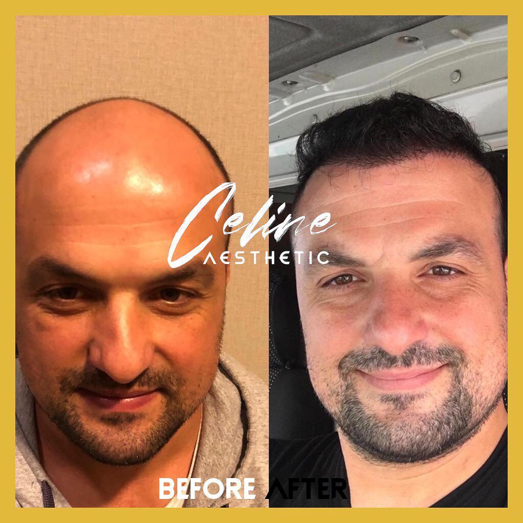 hair transplant ali mezdeği before after 6