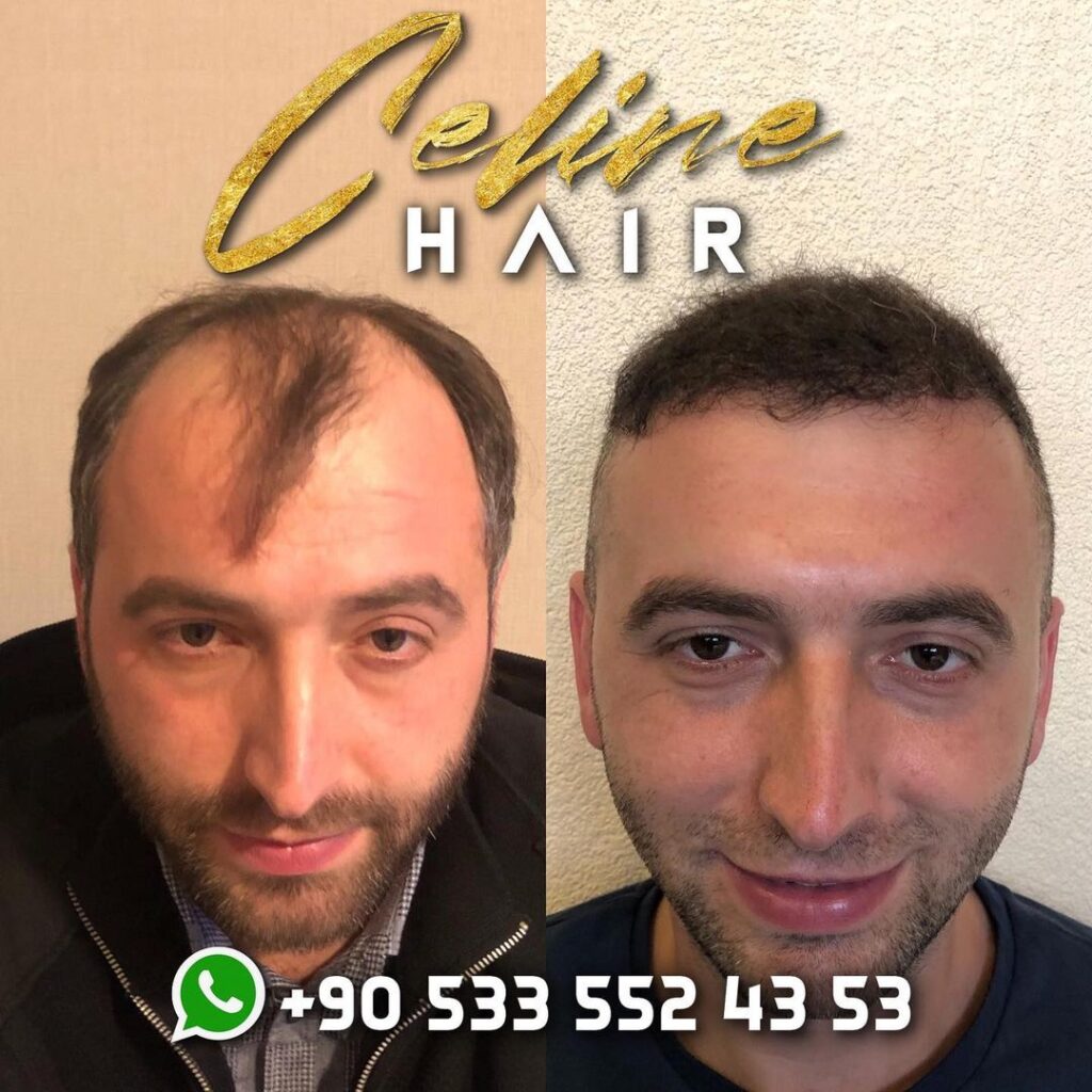 hair-transplant-ali-mezdegi-before-after-9.jpg