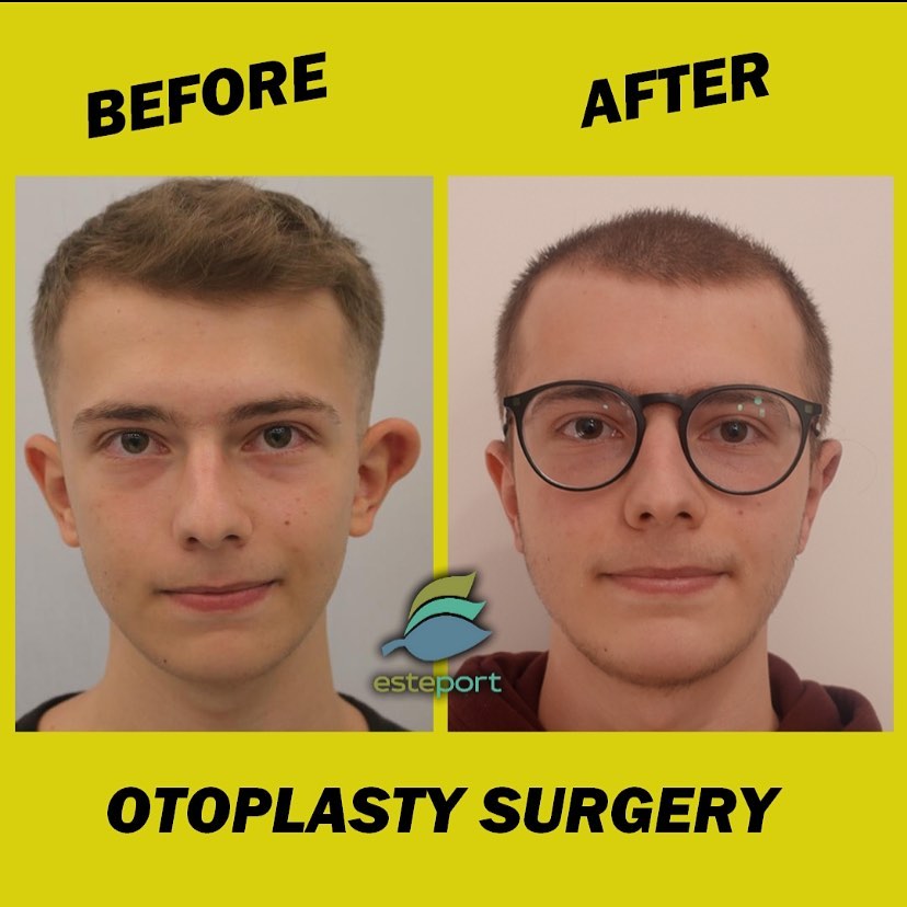 otoplasti before after 1