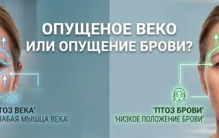 Нависли веки или опустились брови